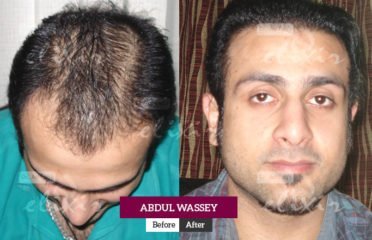 Elixir Hair Transplant & Cosmetic Surgery Center Islamabad