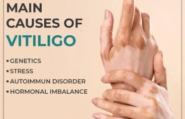 Vitiligo Treatment | Institute Cosmetique | skin specialist in Lahore , dermatologist in Lahore, hair transplant in LahoreVitiligo Treatment | Institute Cosmetique | skin specialist in Lahore , dermatologist in Lahore, hair transplant in Lahore