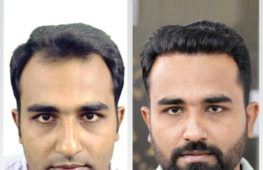 Hash Hair Transplant in Karachi – ICE FUE Transplantation