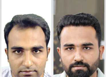 Hash Hair Transplant in Karachi – ICE FUE Transplantation
