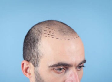 Hash Hair Transplant in Karachi – ICE FUE Transplantation